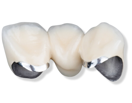 Mão sứ kim loại