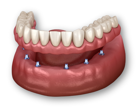 Implant-Supported Dentures
