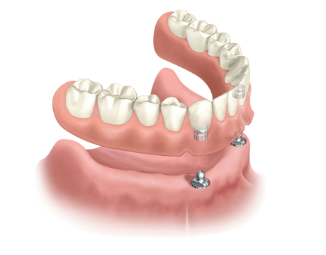 Snap-On Dentures