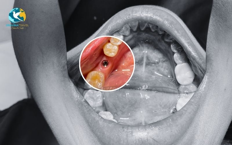 Dental implant in Vietnam are an excellent choice