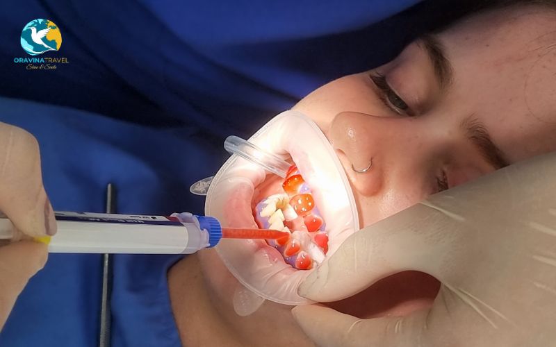 LED bleaching technology at Dr.Smile