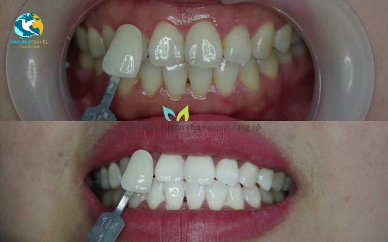 The results are long-lasting