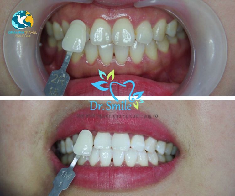 teeth whitening Vietnam cost