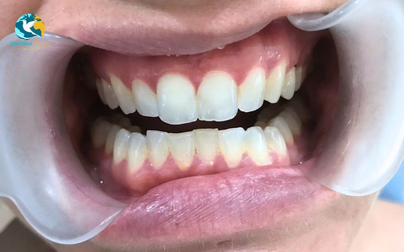 Ultra-thin technology