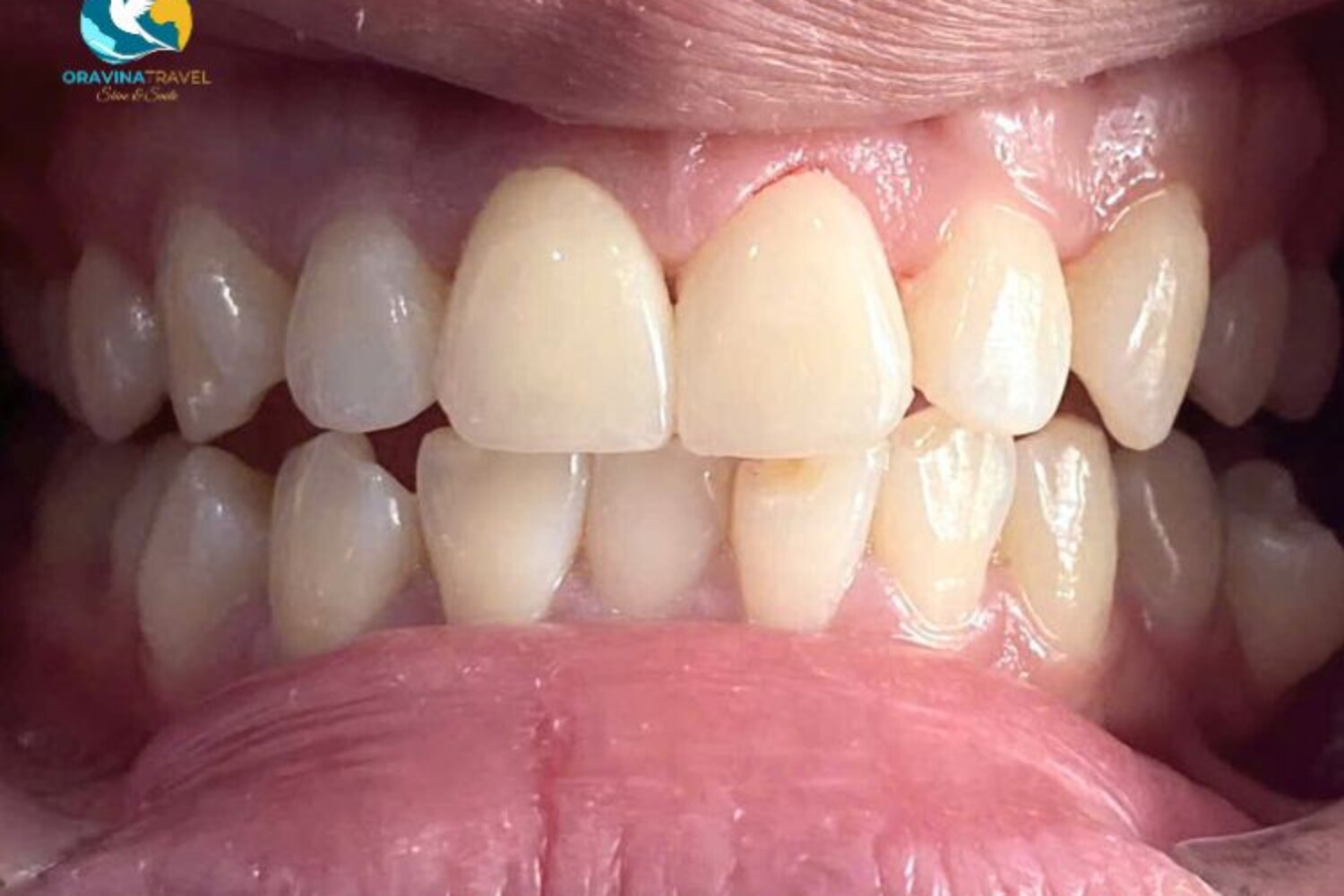 veneer dental tour Vietnam