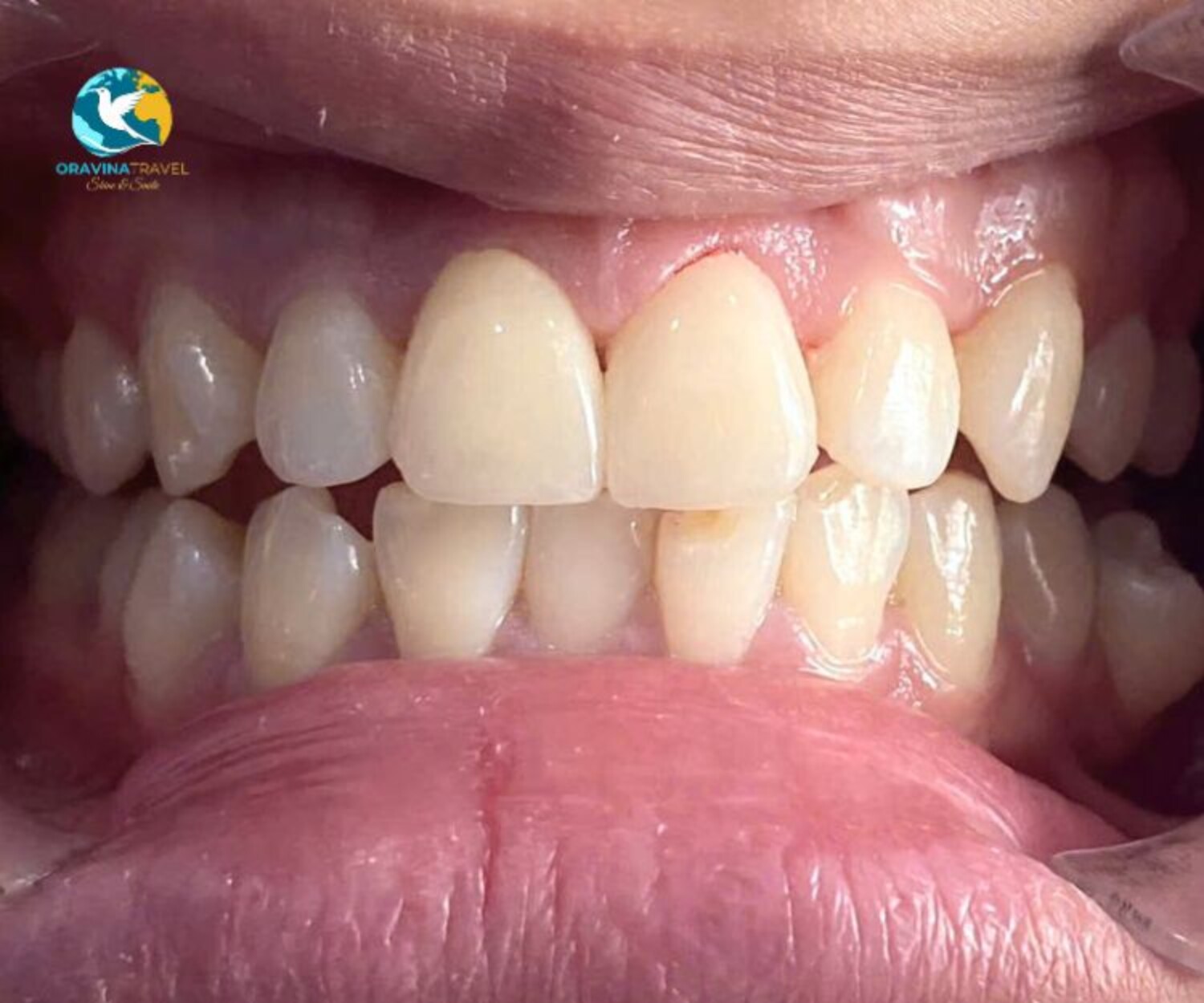 veneer dental tour Vietnam