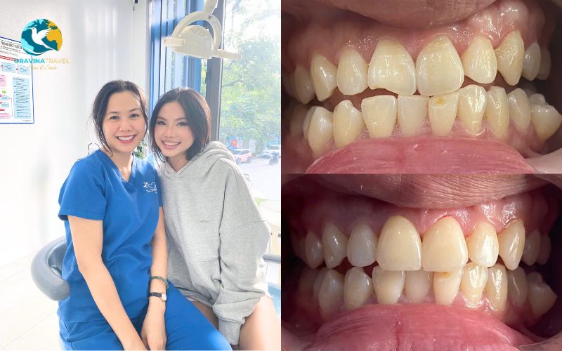 Those who want a quick smile aesthetic improvement 