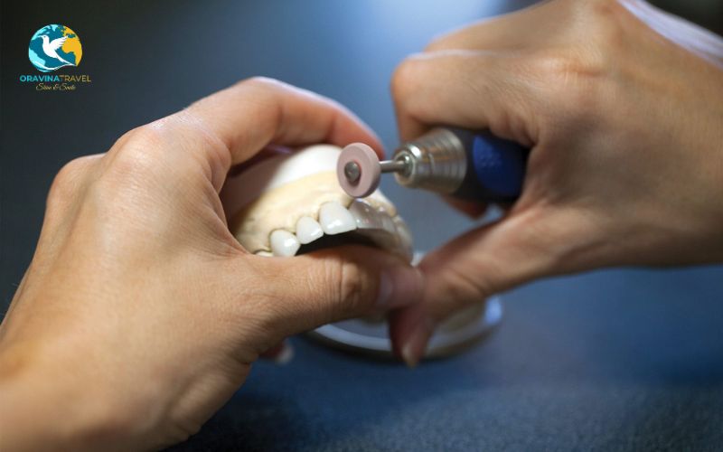 The veneers are custom-fabricated in the dental lab